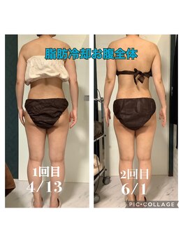 パラアモール(Paraamor)/お腹の脂肪冷却は美尻にも★