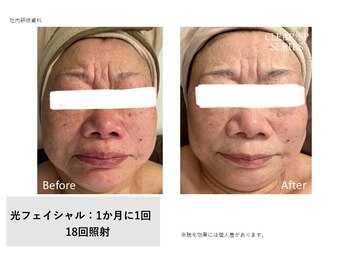 イル 名取店(iru)/光フェイシャル