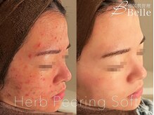 ベル 八王子(Belle)の雰囲気（【お得な回数券も*】ダーマ/ハーブピーリングでニキビ毛穴ケア）