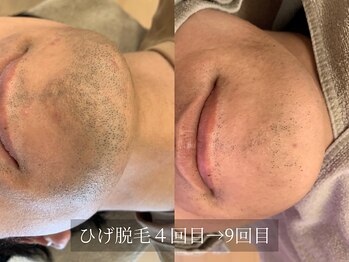 アルム(Arum)/ひげ脱毛