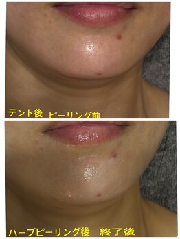 ケーアンドケー(K&K)/ハーバルピーリング3回目のBA