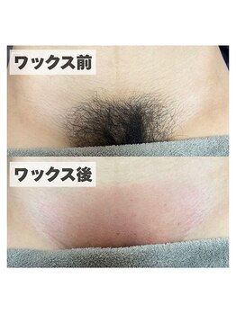 カナウ(KANAU)の写真/【肌荒れ・カミソリ負け・ザラザラ卒業！】しぶといVIOを徹底脱毛します！清潔感が上がり快適になります！