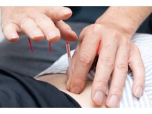 鍼により手では届かない深部の筋肉までほぐします