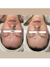 ルアラナ(Lualana)/コース1回の変化☆