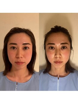 イロドリ 浦和美園(irodori)/小顔整体Before＆After(3回目)
