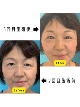 ネクスフィット(Nexfit)/小顔矯正フェイスリフトの効果