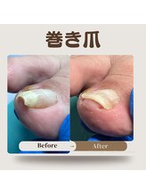 巻き爪補正店 那覇店/