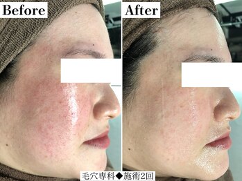 フレイヤ(FREYA)/ララピールBefore→After