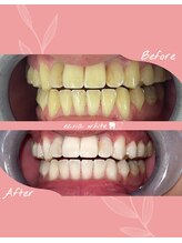 エクシアホワイトニング 札幌中島公園店/ホワイトニングビフォーアフター