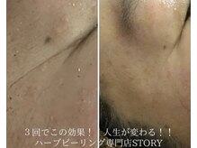 ストーリー 岐阜店(STORY)/ハーブピーリング専門店STORY