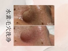 ビシア(Bicia)/水素毛穴洗浄