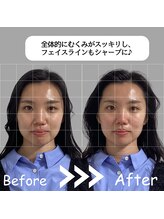 ゆしんアネックス/美容鍼のビフォーアフター♪