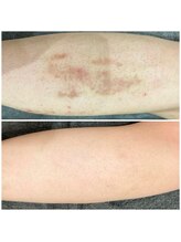 ビオラス(VIOLUS)/20代男性/全身脱毛