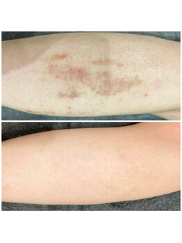 ビオラス(VIOLUS)/20代男性/全身脱毛