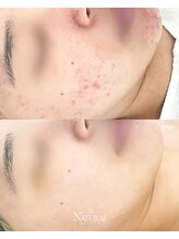 ユーエステティック(U AESTHETIC)/圧出は技術ではなく、科学です。