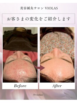ビオラス(VIOLAS)の写真/《自分史上最も綺麗な肌作り》完全個室×美容鍼灸×女性専門の実力派サロン♪美をサポートいたします＊