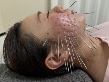 トゥーアズ シャロン(toAZ SHARON)の写真/新コース!“鬼盛り美容鍼”むくみ、たるみ、肌荒れ、食いしばり、ターンオーバー促進などに効果