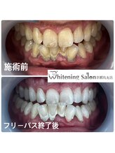 ホワイトニングサロン 京都烏丸店/ホワイトニング施術例