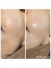 【うぶ毛OFFでトーンアップ美肌へ】フェイシャルWAX！5500円（鎮静パック付)