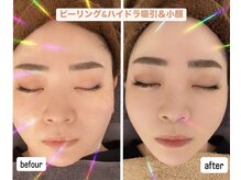 アンドグレイスプラス 恵比寿(&Grace+)の雰囲気（小顔が得意店/水光ララピールとLDM効果絶大で毛穴レスたるみ改善）