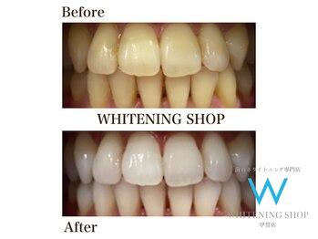 ホワイトニングショップ 甲賀店/Before&After『ホワイトニング』