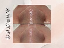 ビシア(Bicia)/水素毛穴洗浄