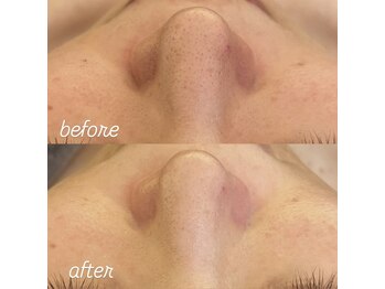 リノ(Lino)/エクストラクションbefore after