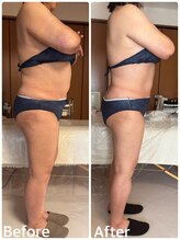 ジフィー(Gify)/筋膜リリースカッターBody