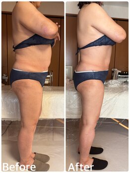 ジフィー(Gify)/筋膜リリースカッターBody