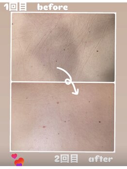 ビースペース 神戸新開地店(Bspace)/背中の黒ずみ徹底ケア