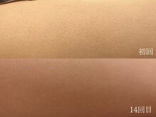 ウォーム(warm)/脱毛/顔脱毛/シェービング