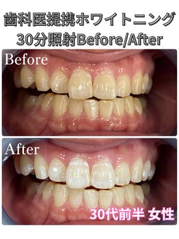 プラチナムビューティ 四条烏丸店(PLATINUM Beauty)/ホワイトニング!Before./After!
