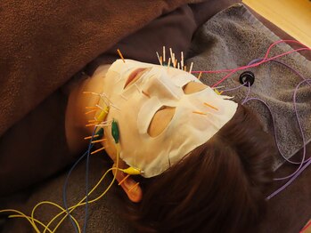 鍼灸屋 小久保拓郎/美容鍼☆