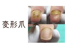 巻き爪補正店 那覇店/