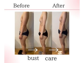 サロンツキ(salon tuki)/バストアップ症例/徳島