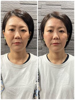 長寿鍼灸院 長寿整骨院/美容鍼50本の効果★小顔効果