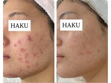 ハクビューティー(HAKU BEAUTY)/ニキビケア改善できる？