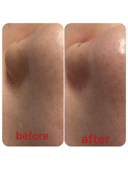 メンズ脱毛＆ヘッドスパ MEN'S with Lilina. 新横浜［ヒゲ脱毛/全身脱毛/VIO脱毛］/ ハイドラ　毛穴吸引洗浄/新横浜