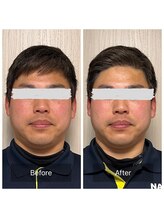 鍼灸院 はりのひと/男性にも◎クイック美容鍼♪