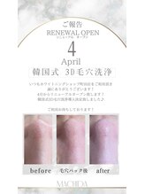 ホワイトニングショップ 町田店/【韓国式3D毛穴洗浄】大注目