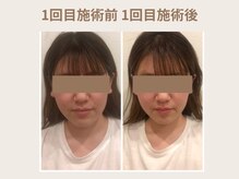 オムリス鍼灸接骨院/before after/美容鍼/駒込店