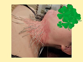 はりきゅう和 ルート鍼灸院/喉の施術