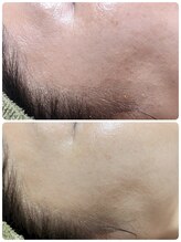 ル クラージュ(Le courage)/バクテリウムピール(40代女性)