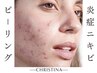 CHRISTINA【ニキビケア専用アクネピーリング】繰り返す頑固ニキビでお悩み◎