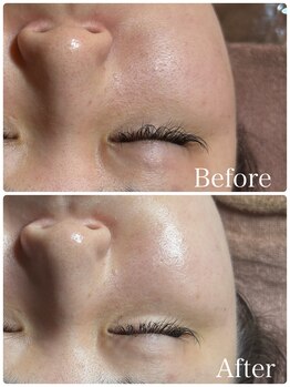 エッセンシャル 南海難波店(ESSENTIAL)/【REVI】ハーブピーリング