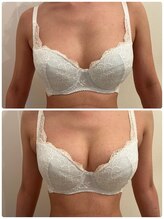 美人バスト 浦和店/【バストアップ★育乳】症例