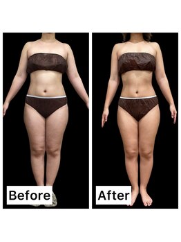 クールヴィラ(Cool Villa)/下腹ビフォーアフター