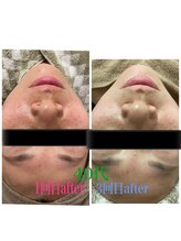 リヤン(Lien)/ヒト幹細胞ELポレーション