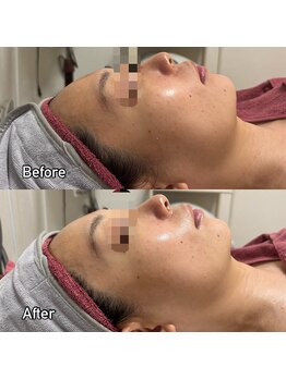 オルオル 天神大名店(Olu-.olu.)/PLAWAVE/肌管理/小顔/艶肌/