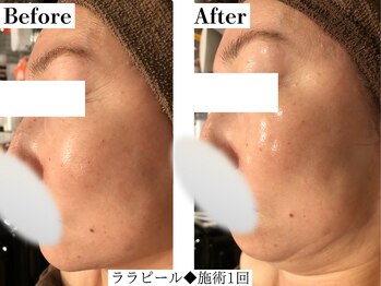 フレイヤ(FREYA)/ララピールBefore→After